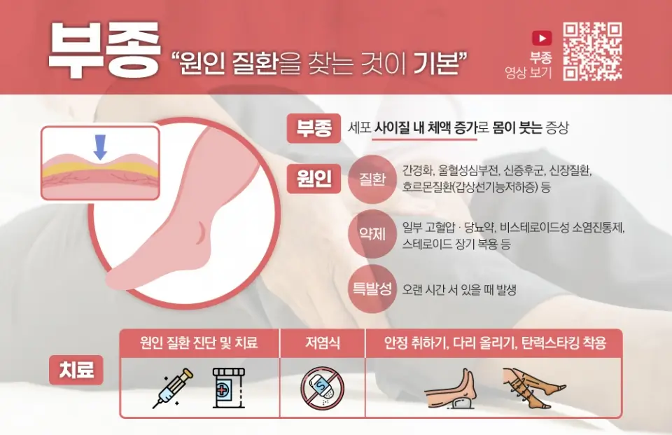  부종의 원인을 파악하고 지속적인 관리법을 알아보자