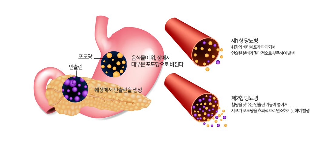 당뇨병-초기증상-알아보기