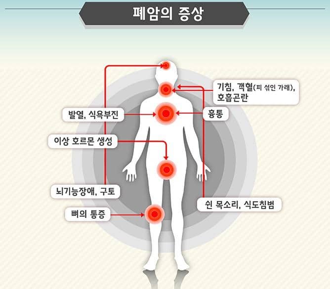 폐암 증상