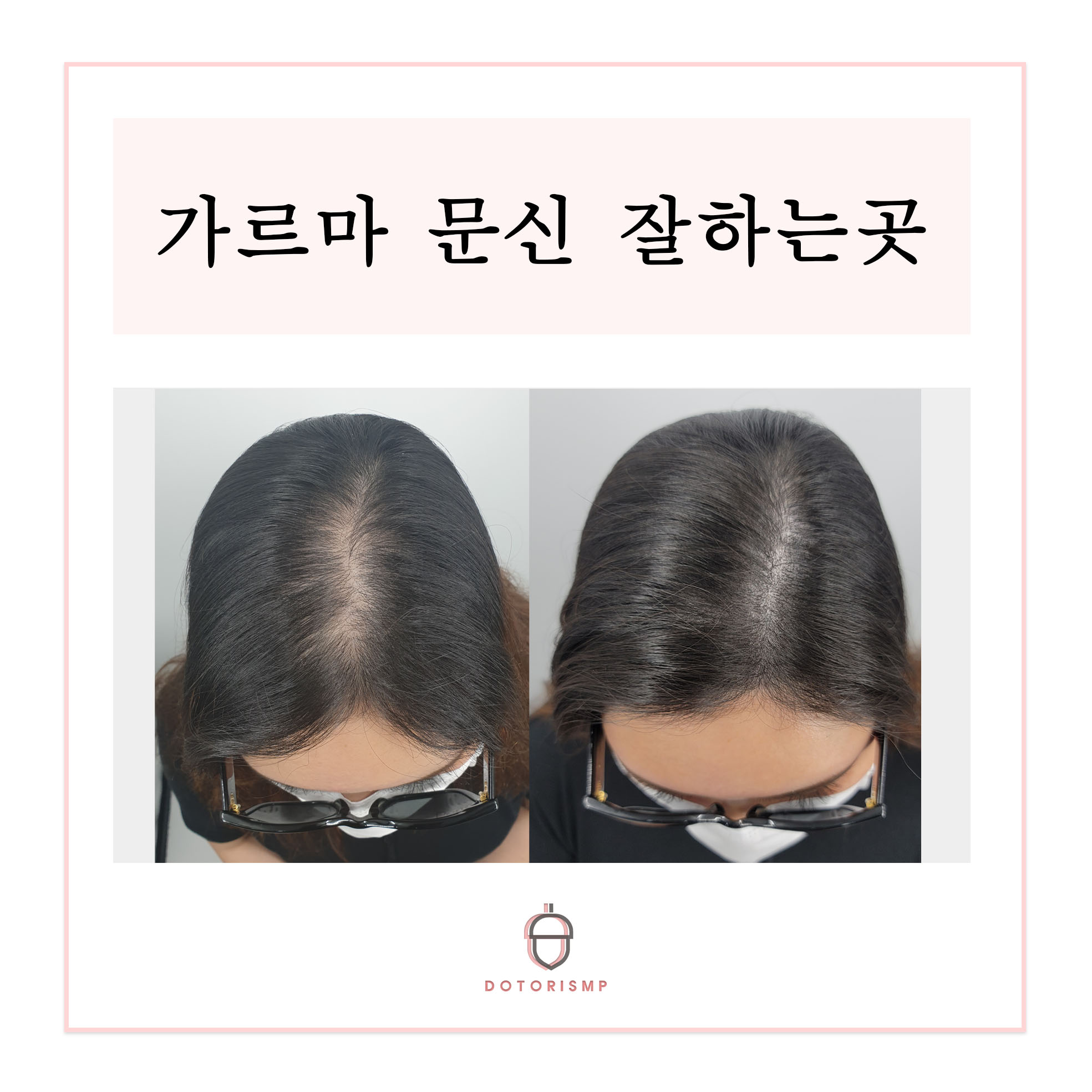  [부산두피문신] 여성 가르마 문신 잘하는곳