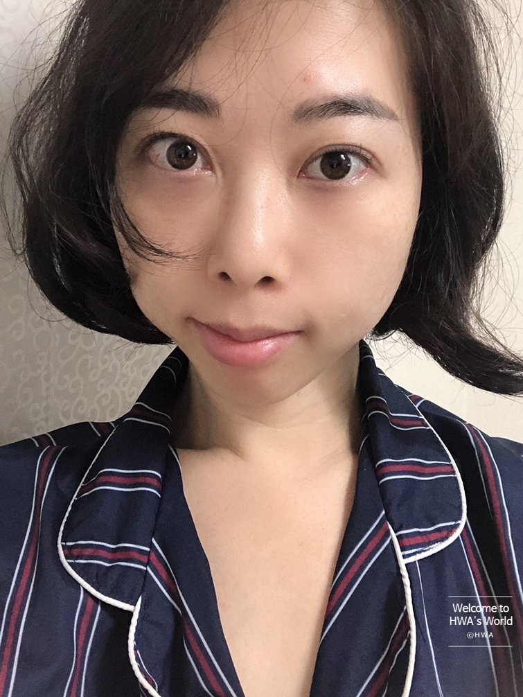 콧볼 축소 비용 [강남/보톡스] 콧볼축소주사-후기 10