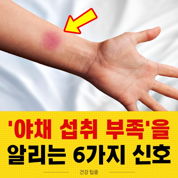 야채 섭취 부족 증상, 멍이 잘드는 이유, 채소 섭취 부족 증상, 팁줌