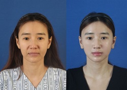 안면윤곽 양악 연예인 전 후 돌이킬 수 없는 부작용 안면윤곽 양악 연예인 전 후 돌이킬 수 없는 부작용