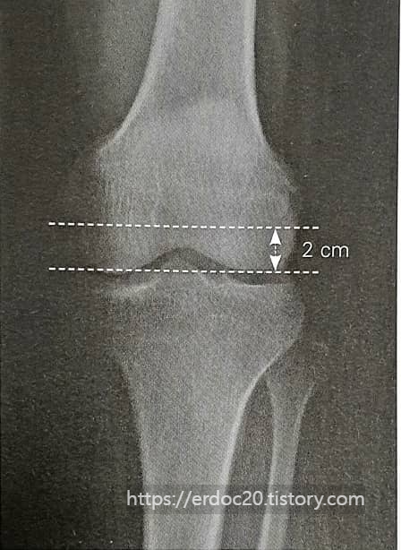 정상 슬개골과 대퇴골의 거리 사진