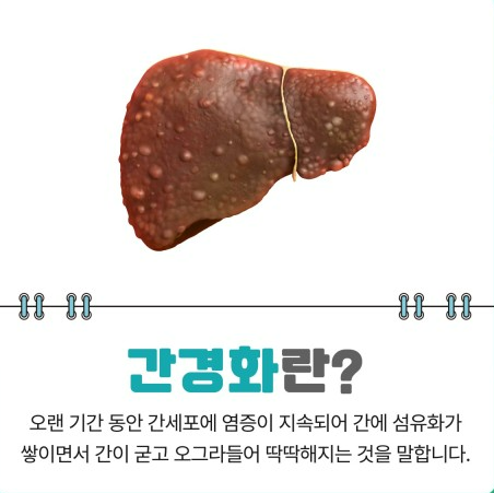  간질환 '간경화'에 대한 모든것