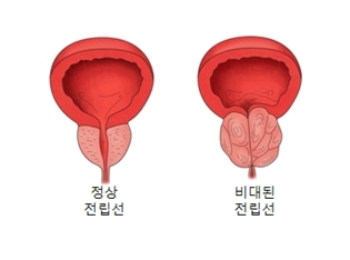 전립선 비대증 사진