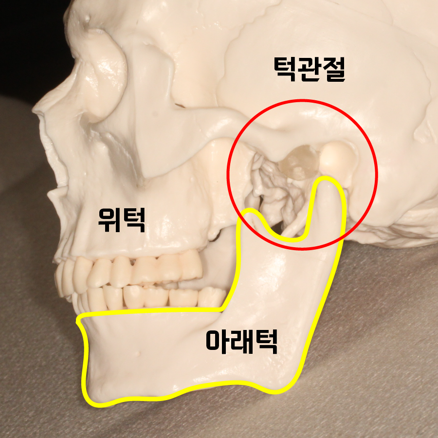 주걱턱 수술 없이 교정 가능한 케이스 옆모습 보기!