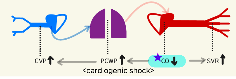 cardiogenic shock