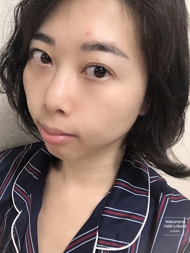 콧볼 축소 비용 [강남/보톡스] 콧볼축소주사-후기 7