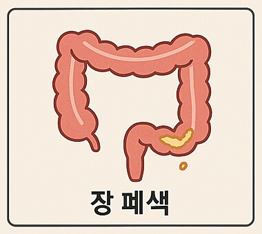 장폐색