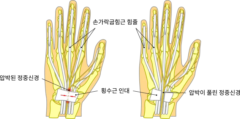 손목터널증후군 증상