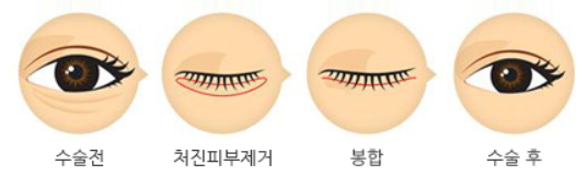  눈 밑 지방 재배치 회복기간/부작용/수술비용