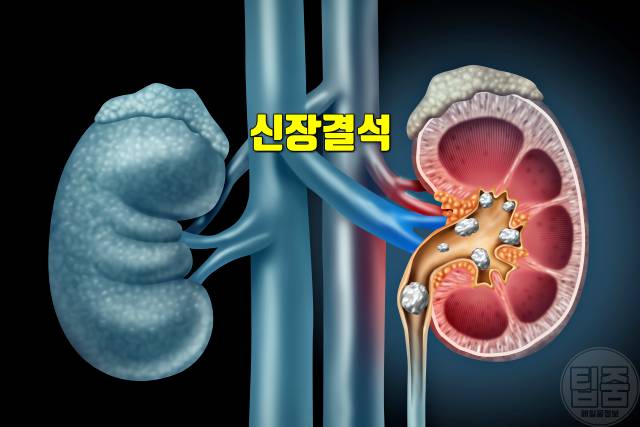 통풍 초기증상 엄지발가락 통증 원인 통풍 증상 신장결석