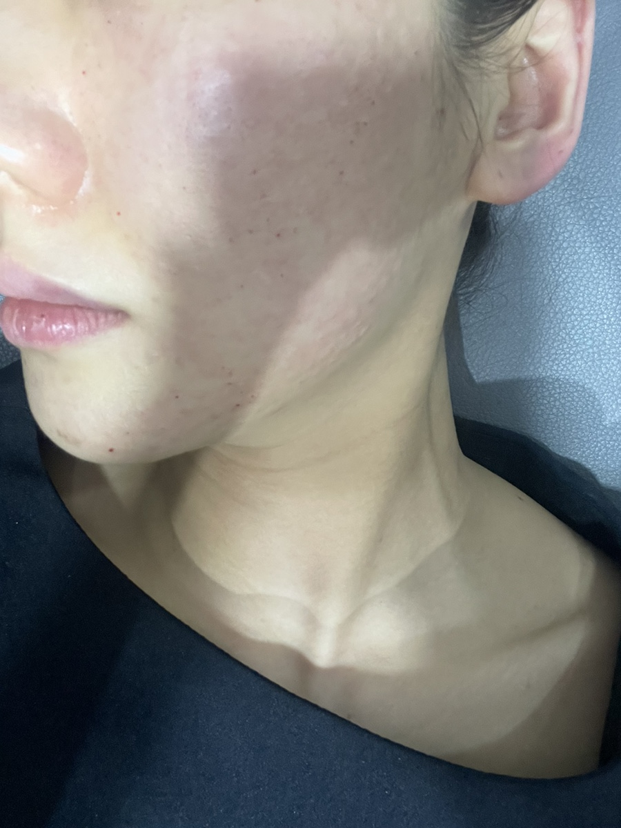 코조각주사 콧볼축소 효과 9