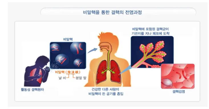  결핵, 완치 가능한 질병: 증상, 진단, 치료 및 예방
