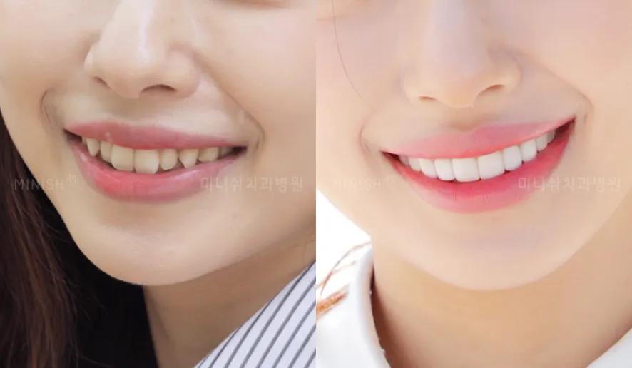 부분틀니 비용