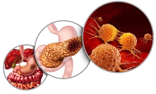 췌장의 역할 췌장암 검사 췌장암 검사종류 췌장암 검사방법 