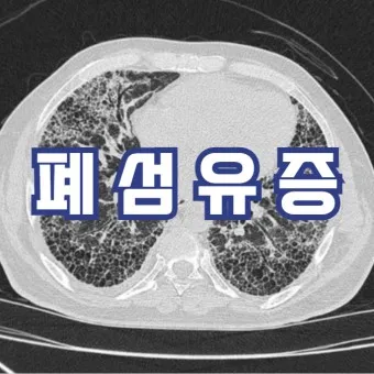 폐섬유증 초기 증상 치료법 관리방법_3