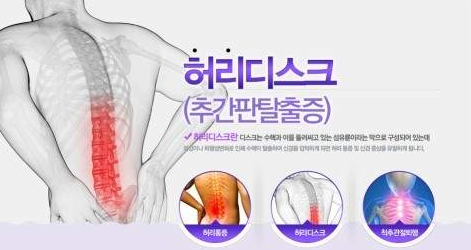  허리디스크 터짐 증상과 비수술 치료 방법 및 좋은 운동에 대해 알아볼까요