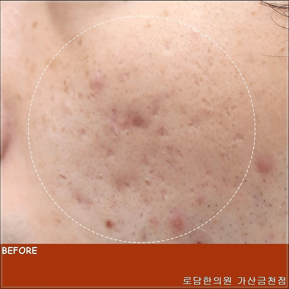  새살침 볼 여드름 흉터 치료 과정