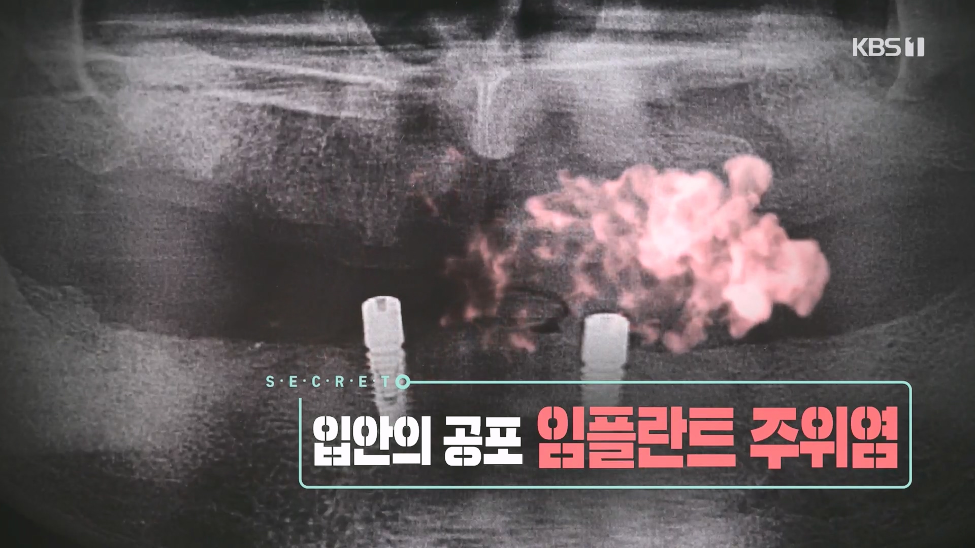 생로병사의 비밀.E890.231213p.H264-F1RST.mp4_20231214_195050.917.jpg