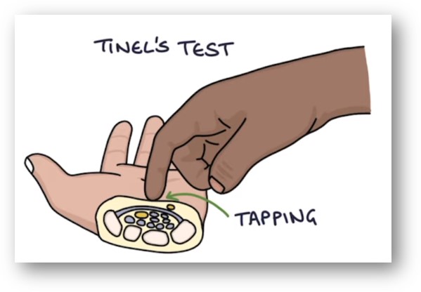 티넬 검사 Tinel&#39;s test