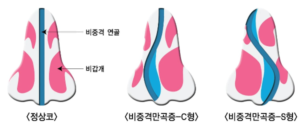 비중격만곡증