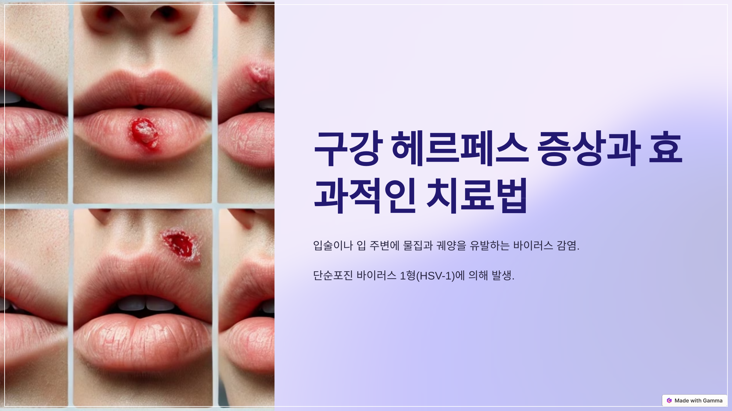 구강 헤르페스 증상과 효과적인 치료법 😷💊