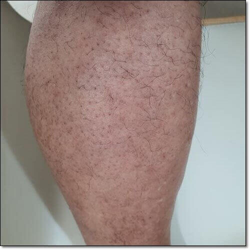  모공각화증 증상 원인 및 예방과 치료