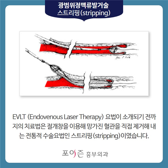 강남흉부외과추천 하지정맥 레이저수술(EVLT) 특징은? 6