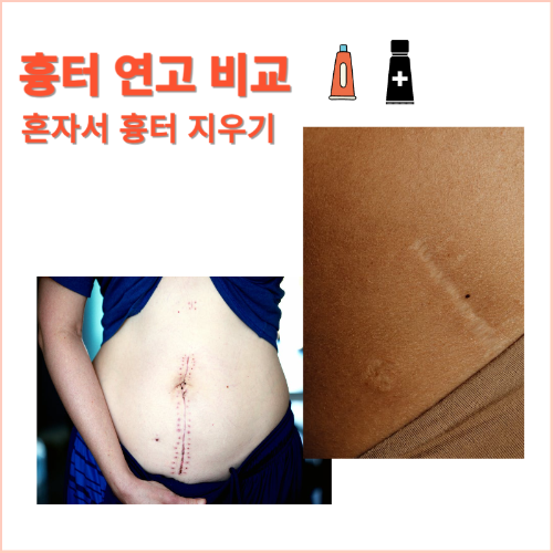  흉터연고 비교 - 집에서 혼자 흉터 지우기