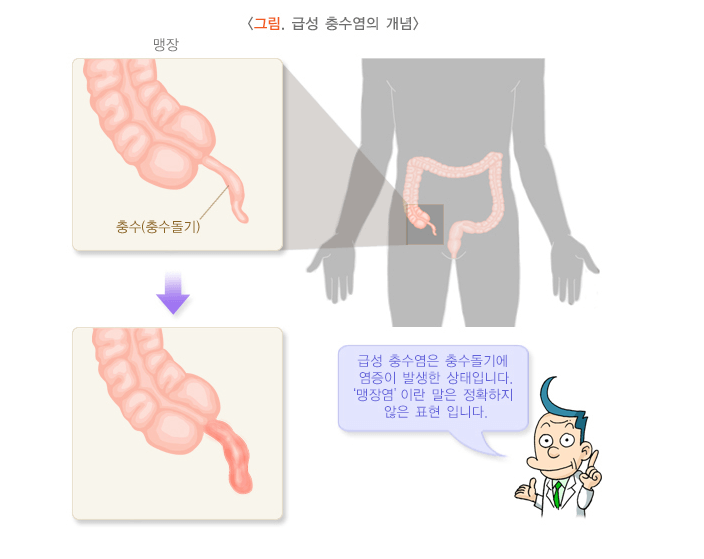 급성충수염개념