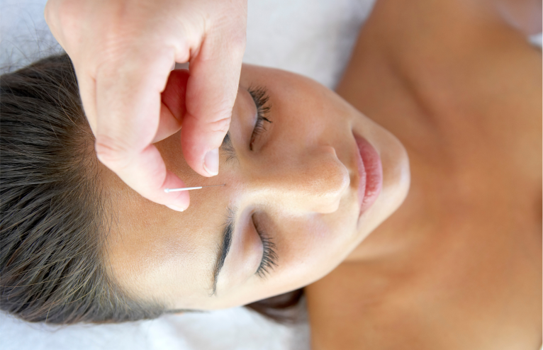  THE HEALING TOUCH: UNLOCKING THE POWER OF ACUPUNCTURE FOR HOLISTIC WELLNESS