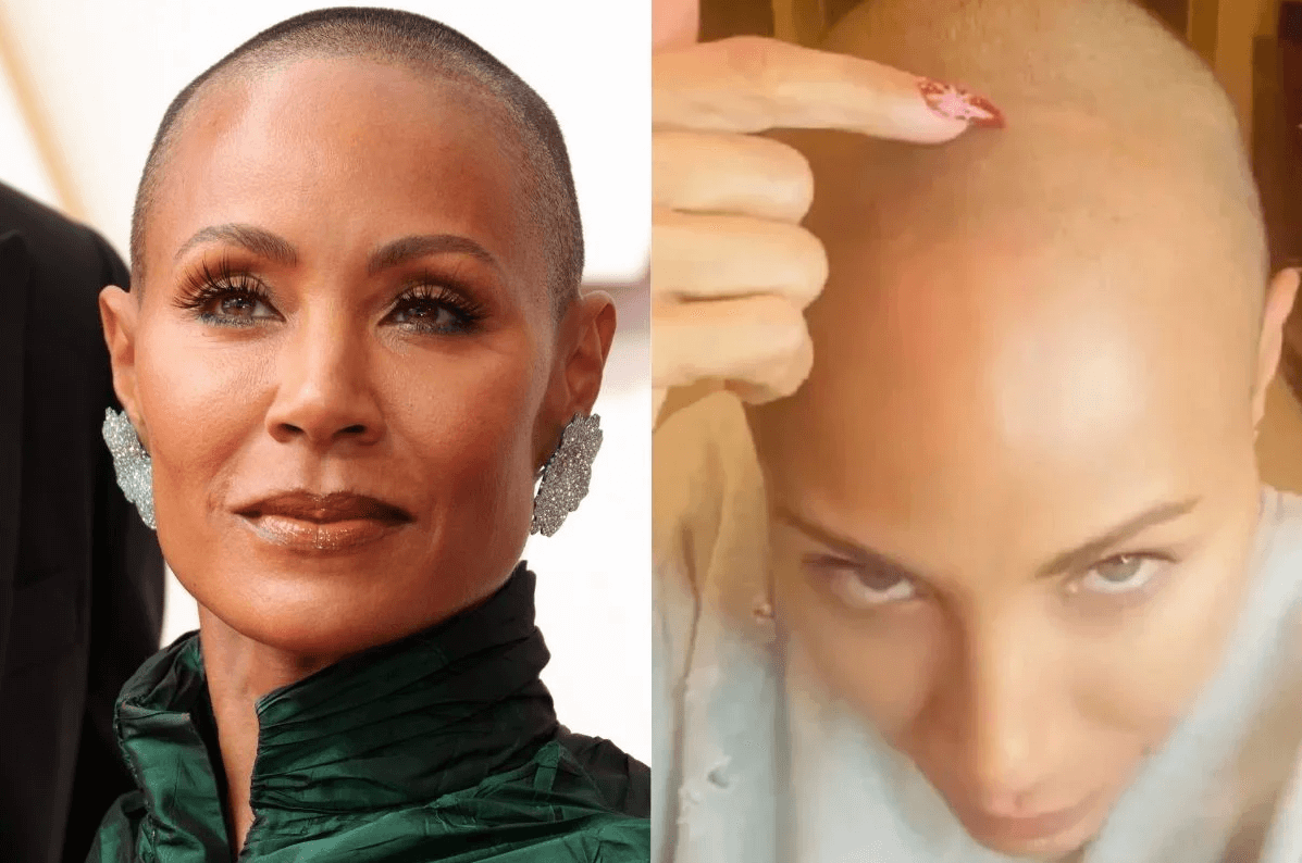 Jada Smith Hair Loss