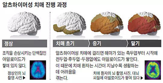 알츠하이머 질환