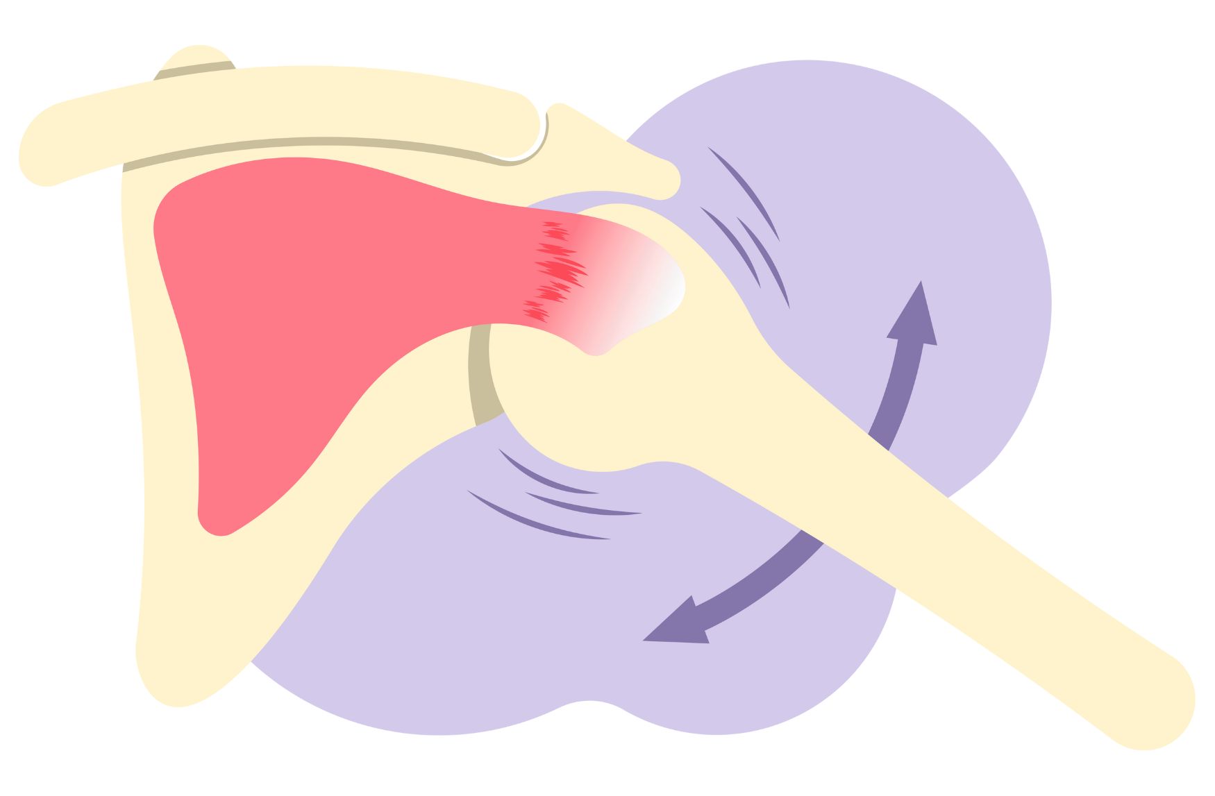 어깨 충돌증후군 재활