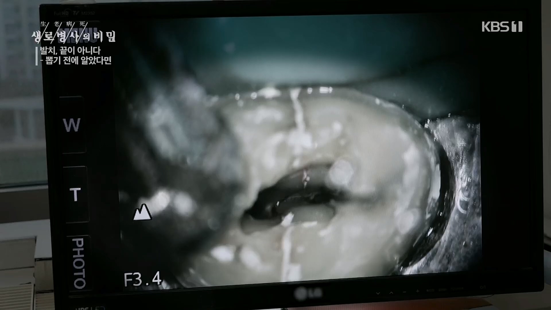 생로병사의 비밀.E855.230208p.H264-F1RST.mp4_20230214_194916.506.jpg