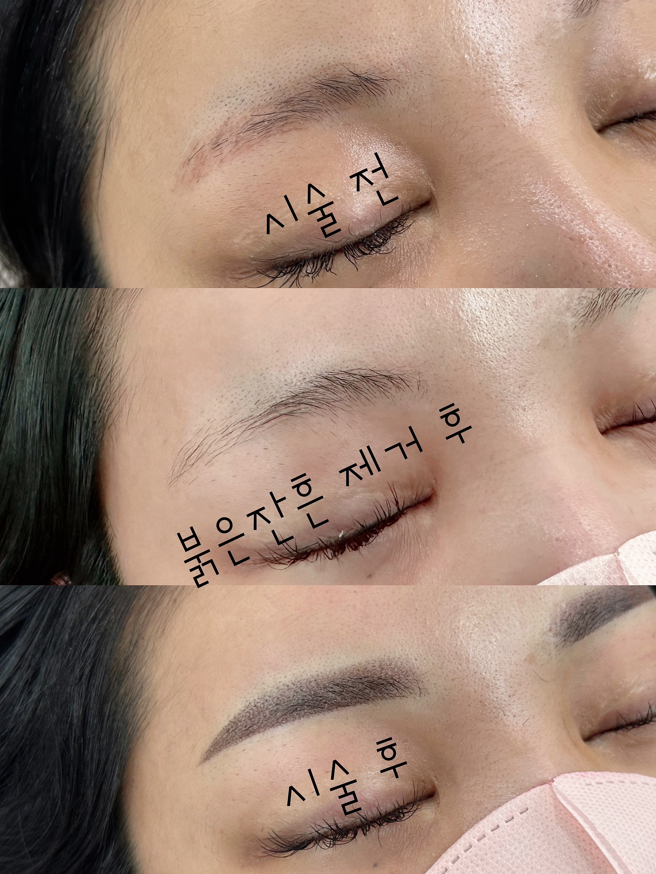  천안 눈썹문신 제거, 일상생활 지장없이 제거하세요