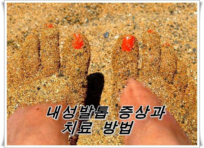  내성발톱의 원인과 치료법이란?