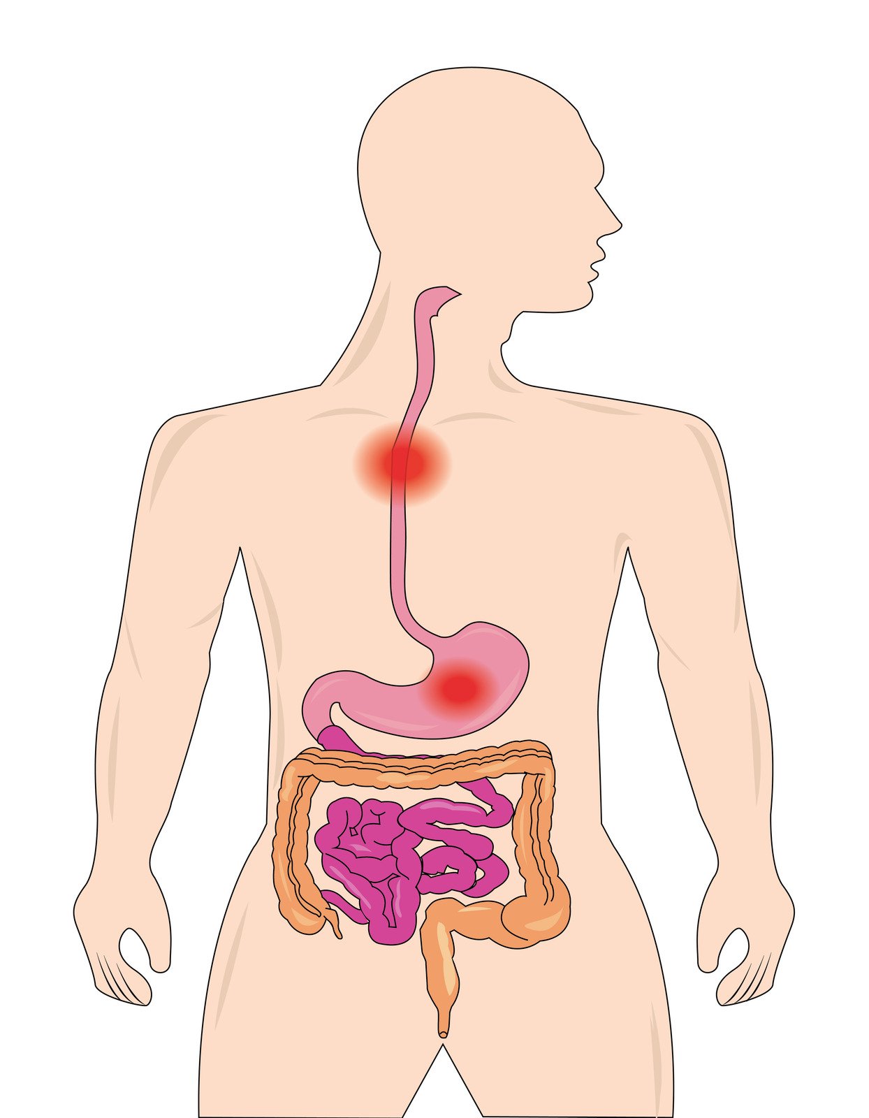 24시간 식도 pH 검사 (24-Hour Esophageal pH Monitoring)