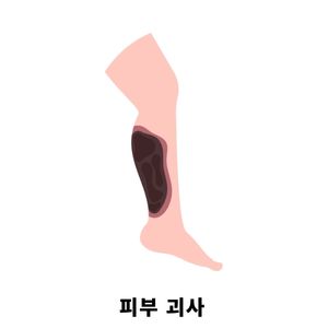 화상 물집 치료방법