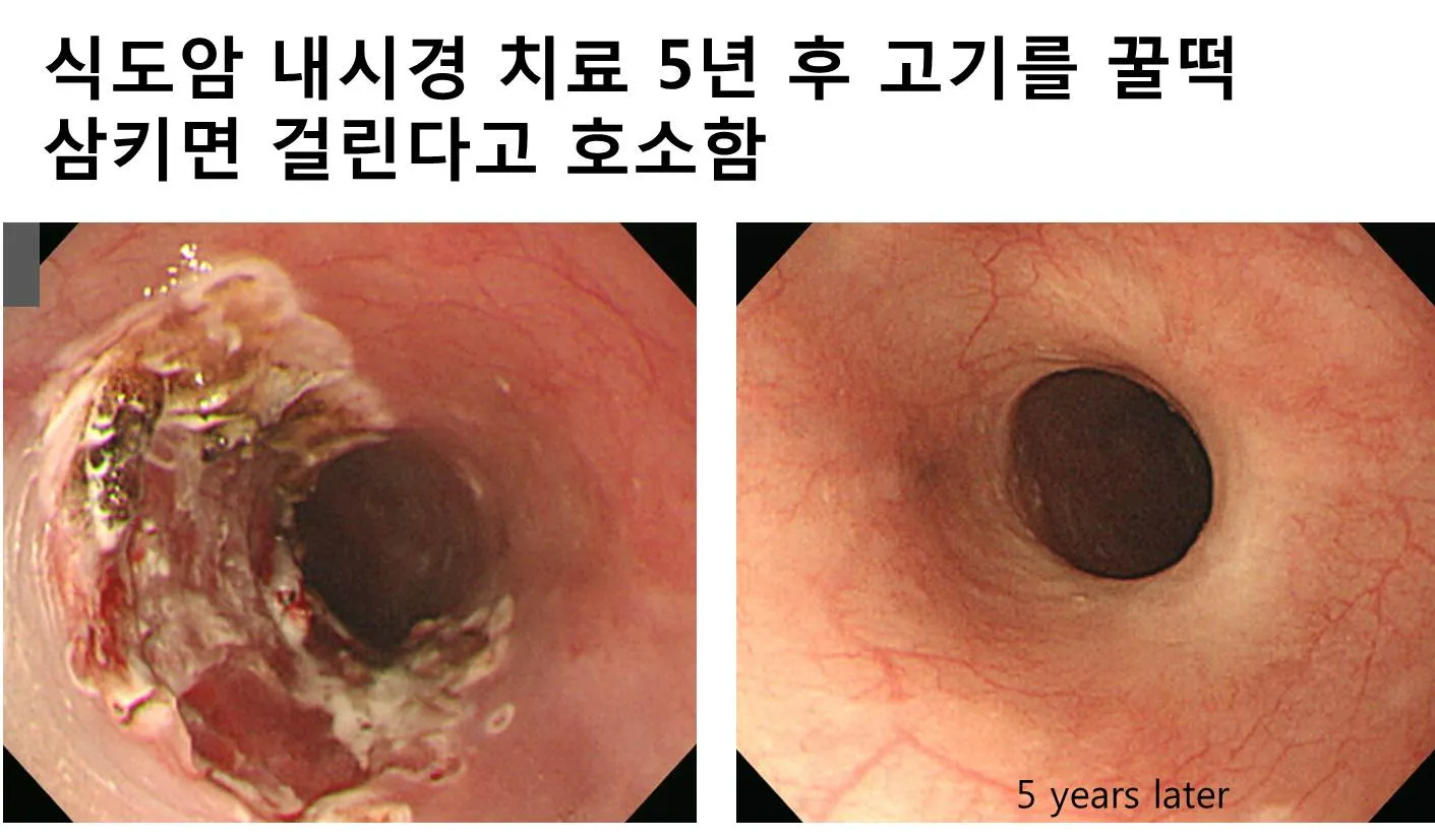 식도암 초기증상