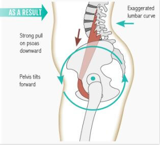 장요근의 수축으로 요추가 당겨지고 그로 인해서 골반이 전방 회전 하게 되는 그림