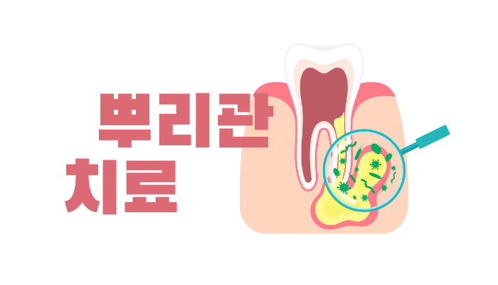 뿌리관 치료