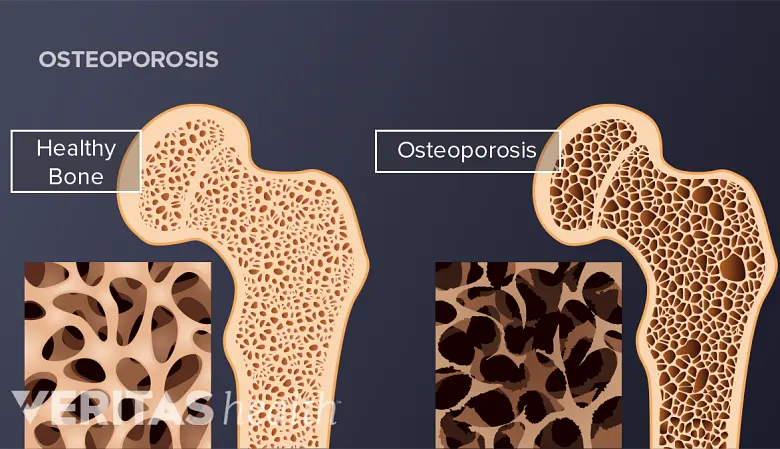 osteoporosis