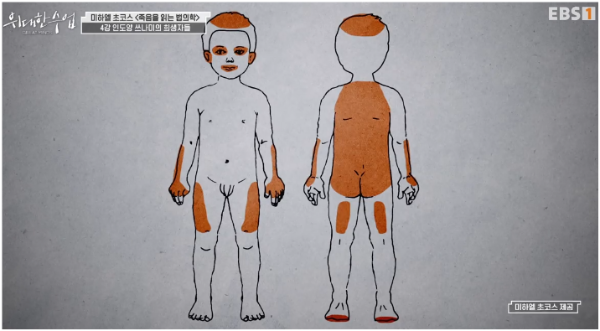 &quot;alt&quot;:&quot;일반적으로 아동이 다치는 부위&quot;