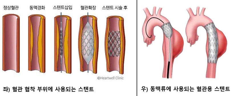 관상동맥-스탠트삽입과정