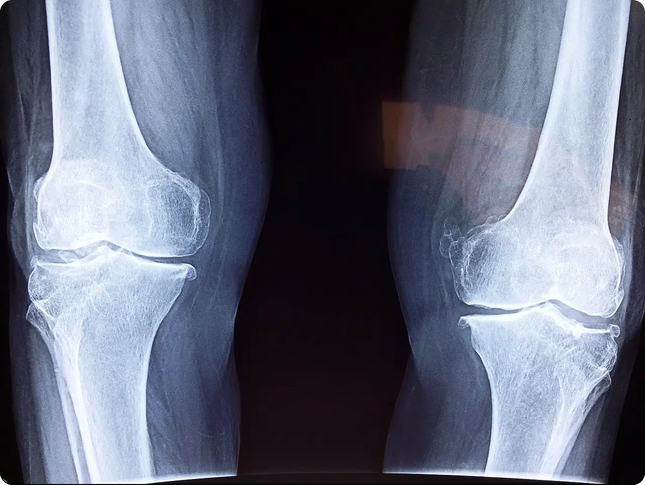무릎 수술을 위한 엑스레이 사진이다.