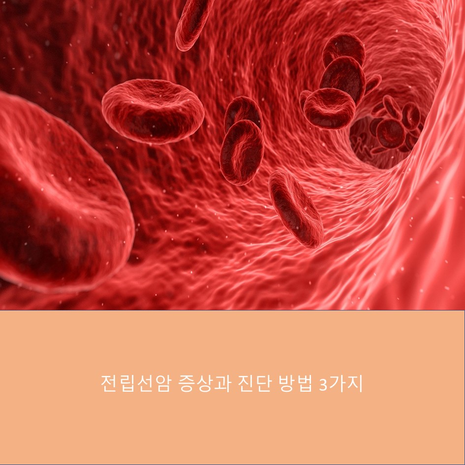  남성의 적 전립선암 증상과 진단하는 방법 3가지