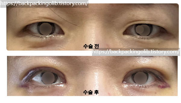 쌍수 비포애프터